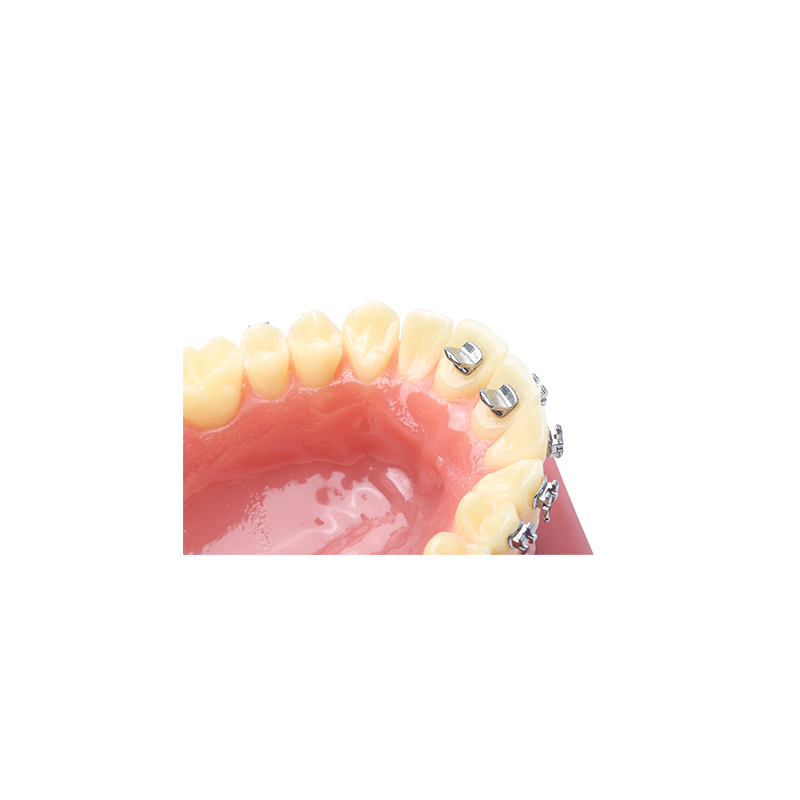 Orthodontic Bite Guide
