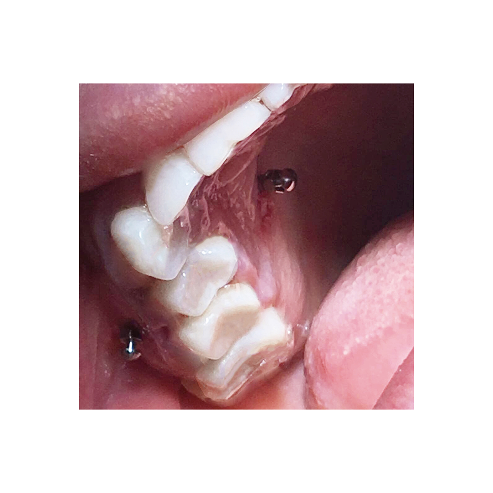 Orthodontic Mini Screw Driver Kit